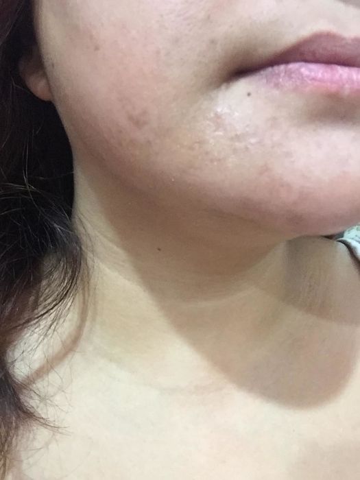 An image of the same reviewer with significantly fewer marks and scars on their face