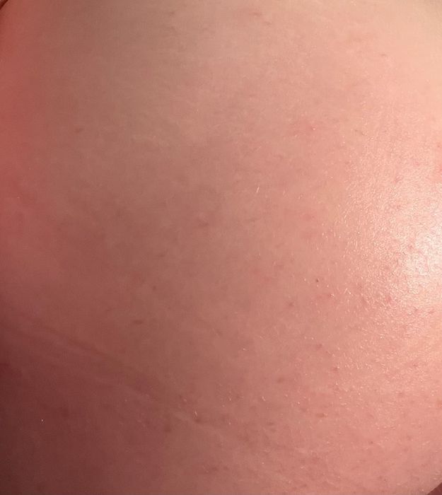 The same reviewer shows a photo of their now-clear, blemish-free skin.