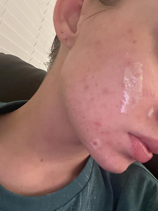 A close-up 'after' image of the same cheek with visibly fewer acne spots.