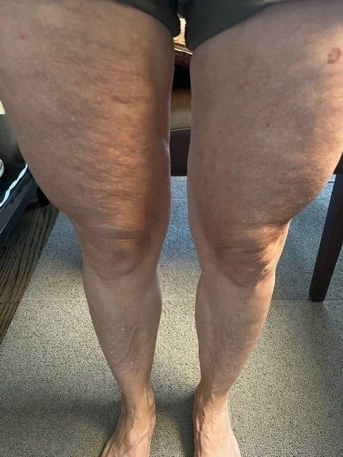 A 'before' image showing a reviewer with cellulite on their legs.