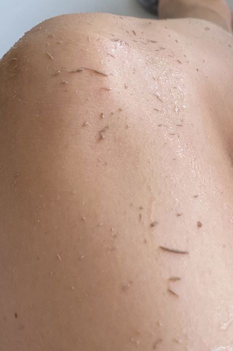 A reviewer's leg covered in layers of dead skin