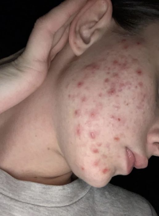 A close-up 'before' image showing a person's cheek covered with acne.