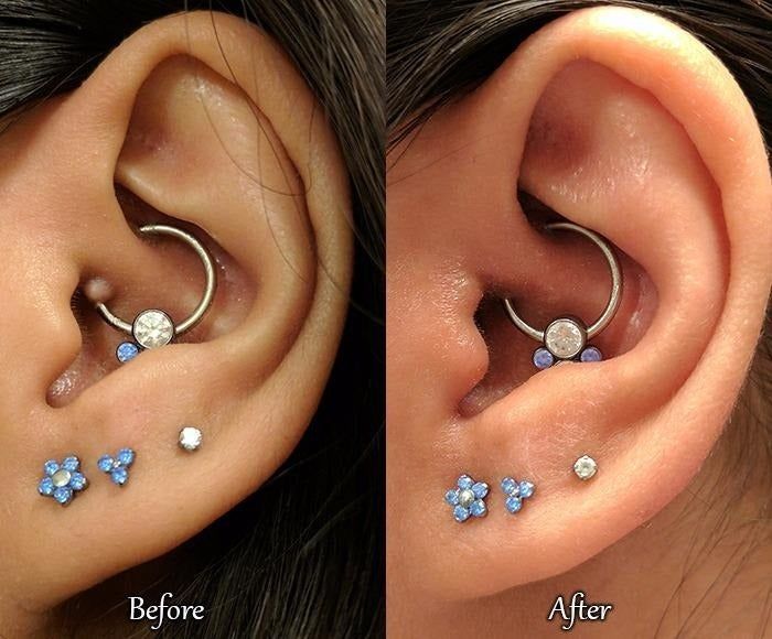 A before-and-after photo showing a bump near the reviewer's ear piercing that disappeared after using the spray.