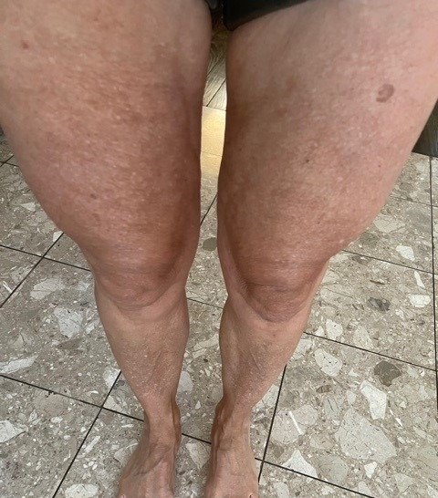 An 'after' image of the same reviewer with noticeably reduced cellulite on their legs.