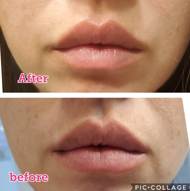 Before using the lip scrub, the reviewer’s lips appear rough and dry; after using the scrub, they look noticeably smoother and refreshed.