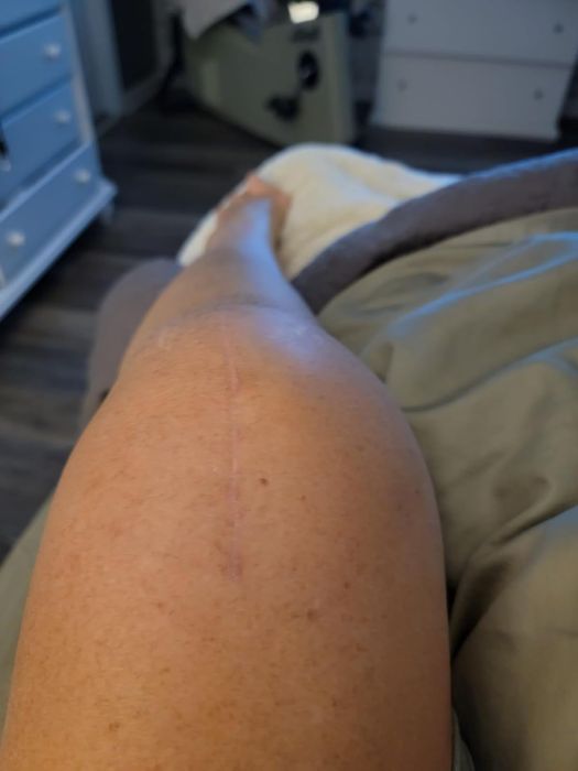 A close-up view of a person's leg resting on a bed, with a faint scar visible along the calf.