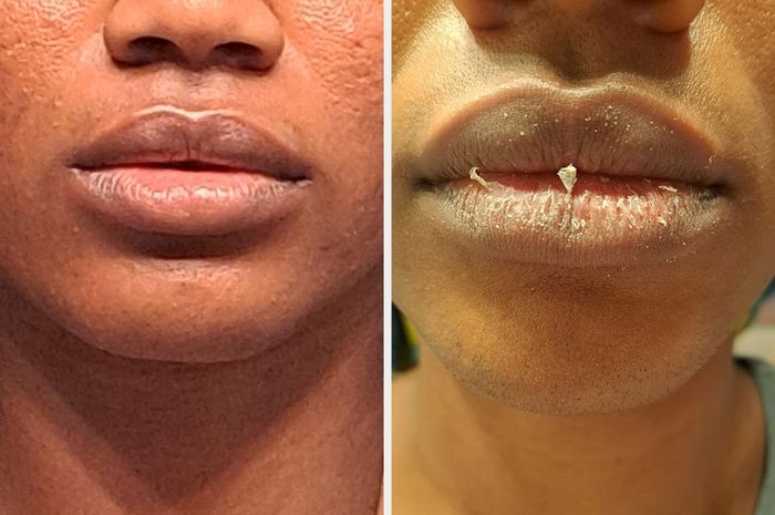 A close-up comparison of two people’s lips; one set appears smooth and hydrated, while the other looks dry and chapped.