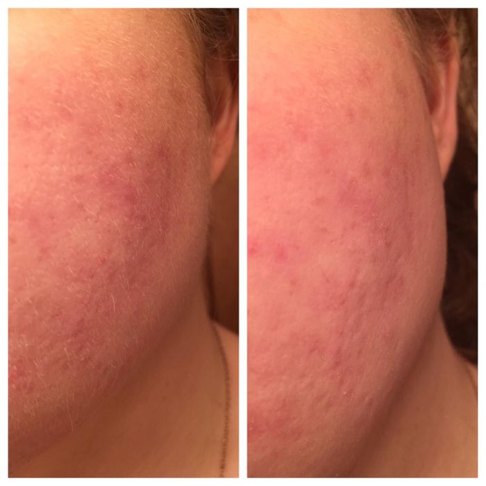 A reviewer's before-and-after showing their jawline with peach fuzz.