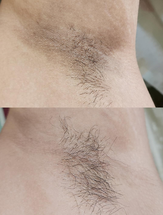 Before using the kojic acid soap, a reviewer’s armpits were marked with dark spots; after using the soap, the dark spots were visibly reduced, leaving clearer skin.