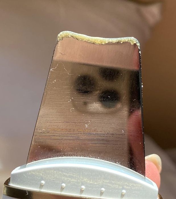 Close-up image of the scraper showing dead skin and sebum extracted from the pores.