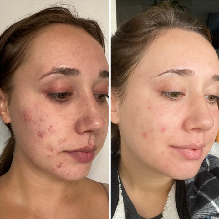 A before-and-after image of a reviewer, showing their acne before and their clear skin afterward.