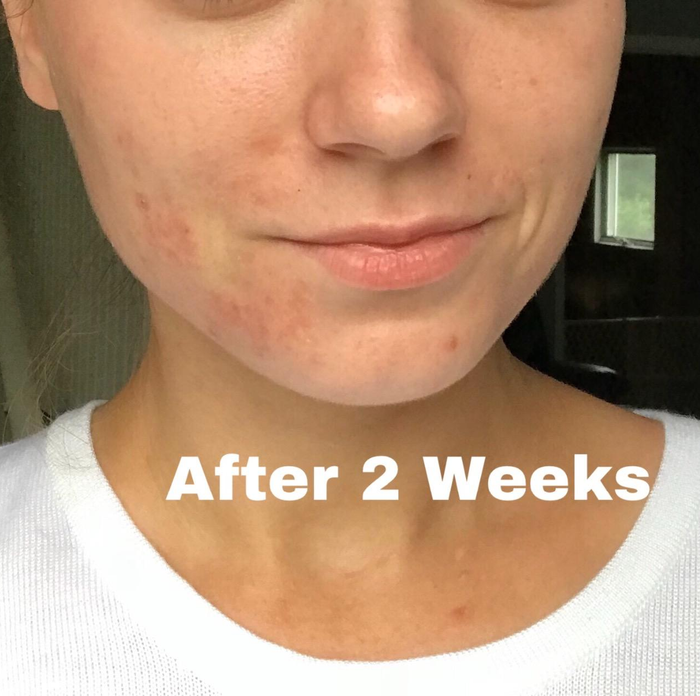 A reviewer’s skin after two weeks of using the snail repair cream, now looking clearer and more even-toned