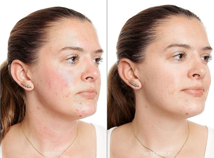 Model with redness on neck and cheeks shown.