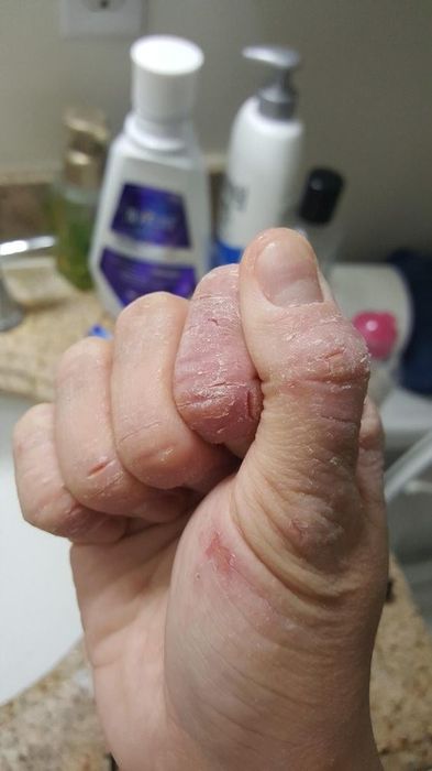 A reviewer’s photo showing dry, cracked hands