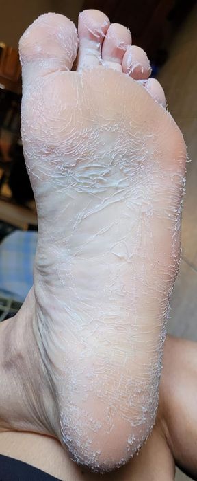 Before: A reviewer’s foot peeling