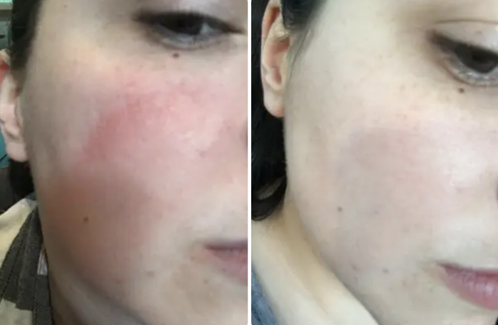 A reviewer's cheek showing redness on the left side, with no redness on the right side after using the cream