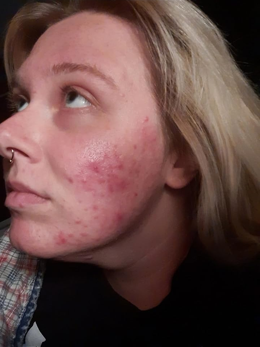 before image of a reviewer with red, acne-covered skin on their face