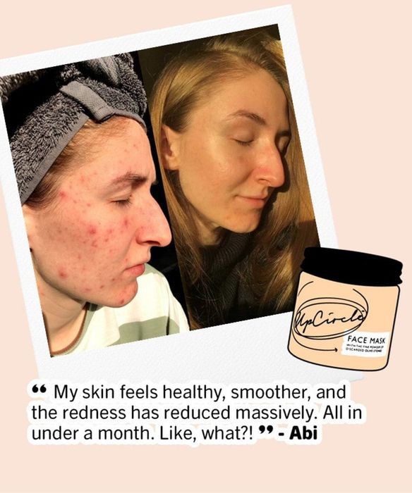 Before and after photos of a person with acne and redness who uses the mask and sees clearer, more even skin; text reads