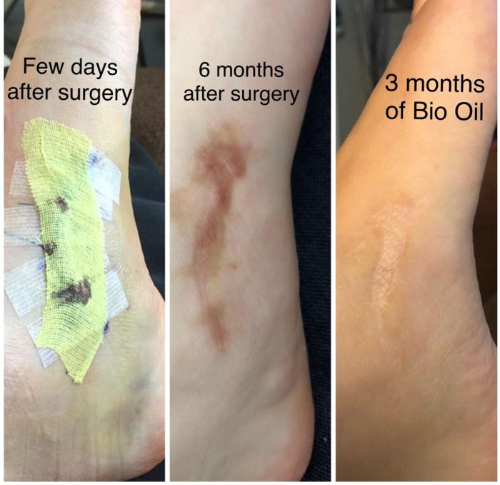 Before and after images of a reviewer showing a scar that fades after three months of use.
