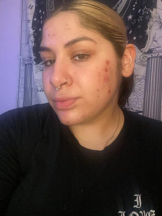 A different reviewer showing their acne.