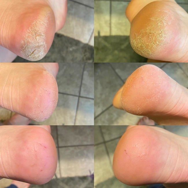 From top left to bottom right: pictures showing a reviewer's heels with dry, callused skin, followed by slightly callused feet, and finally smooth heels after using the foot rasp.