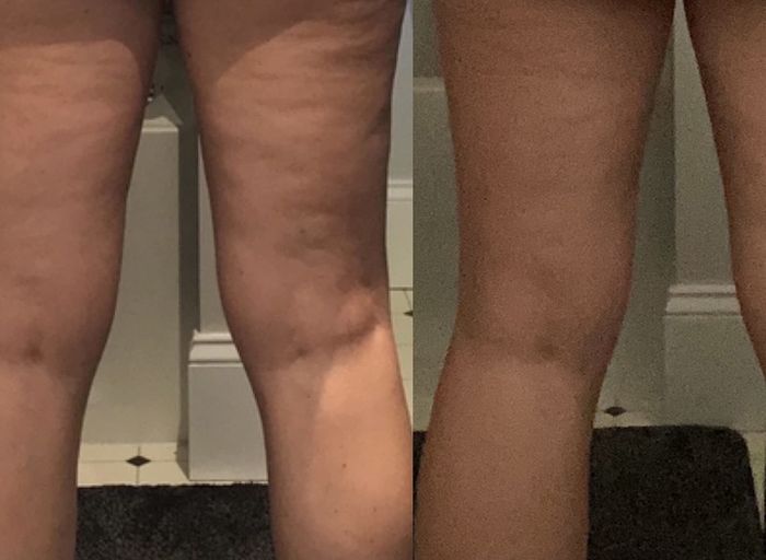 A before-and-after image of a reviewer's legs, showing loose skin before using the cream and firmer, tighter skin after using it.
