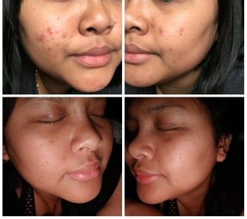 A before-and-after photo showing a reviewer with cheek breakouts and acne scars in the first image, and much smoother, clearer skin in the second image after using the product.