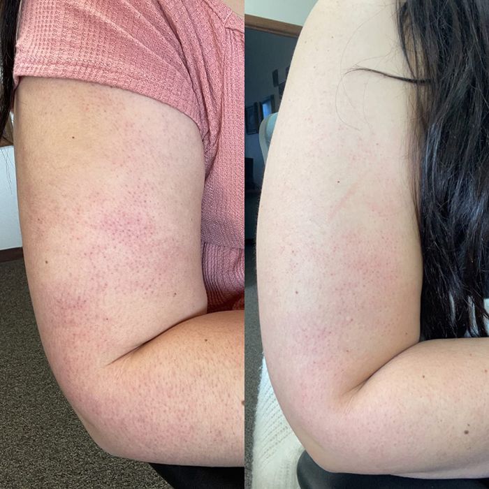 On the left: a photo of the reviewer’s arm covered in small red bumps. On the right: the same arm after using the KP body scrub, showing significantly fewer red bumps.