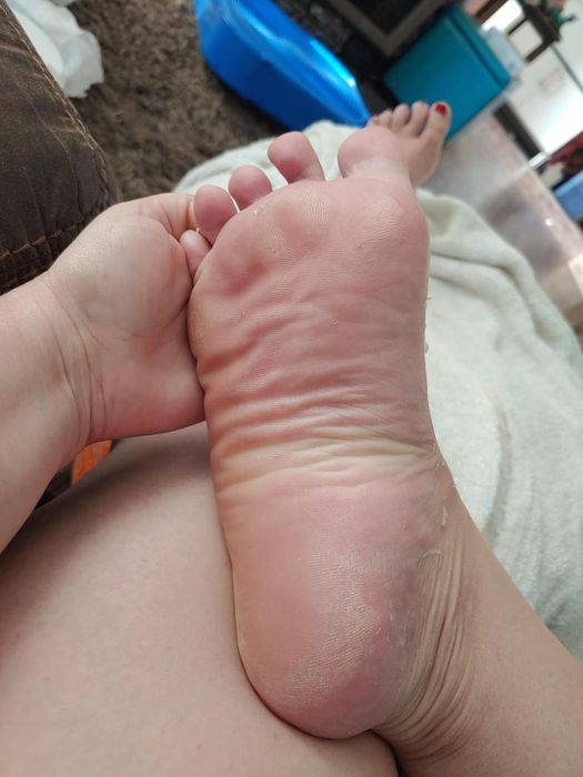 The same reviewer showing their foot after removing all the dead skin.