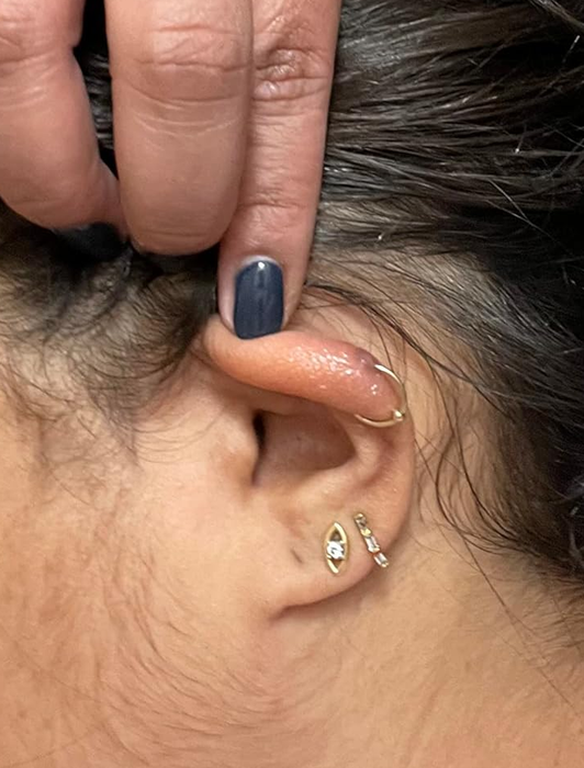 The same reviewer's ear after consistent daily use of the keloid treatment.