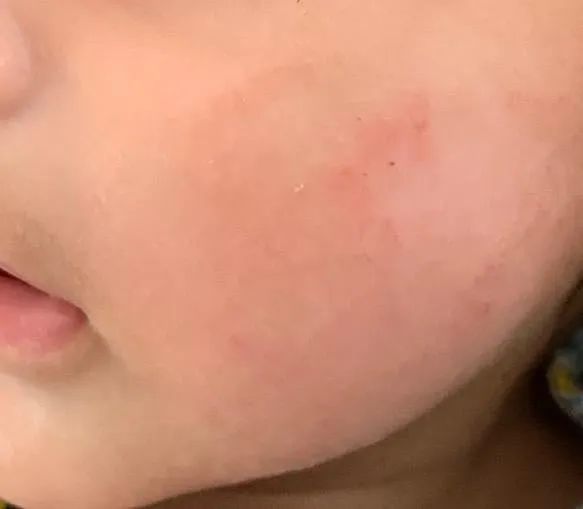 Three days later, a reviewer's child’s cheek is clear and smooth with no signs of irritation.