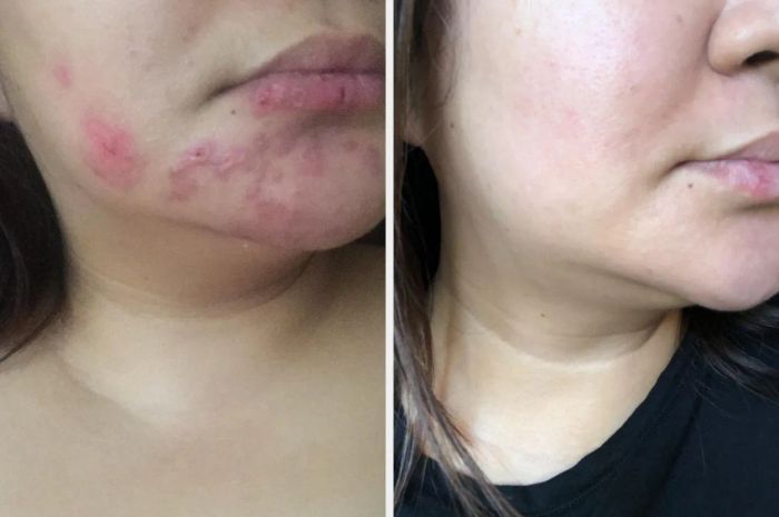 Reviewer with acne scars, followed by an after image showing the fading of the scars.