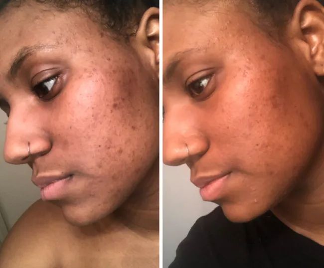 A reviewer showing the results of the Paula's Choice exfoliant, with their skin visibly brighter and blemishes reduced.