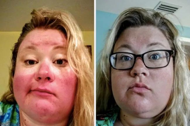 A reviewer shows their face with severe sunburn in the first image, and in the second image, after using makeup, they appear slightly tan instead of sunburned.