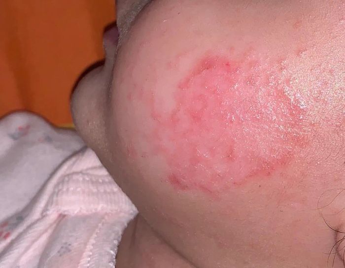 A reviewer's child showing an inflamed eczema patch on their cheek.