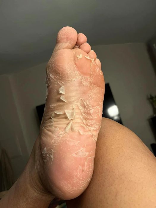 A reviewer's foot showing peeling dead skin after using the foot exfoliation treatment.