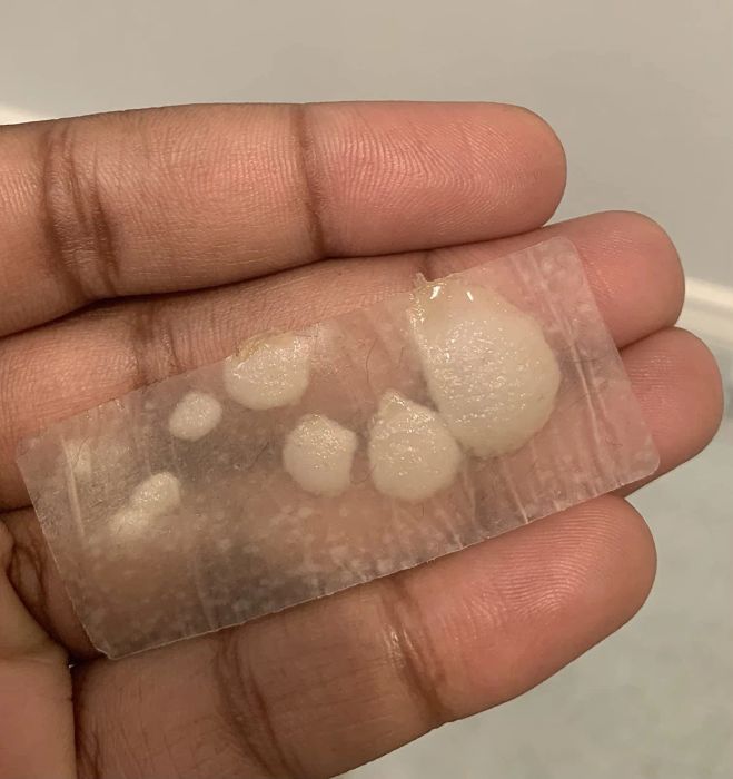 A hand holds one of the patches, covered with large pus circles lifted from zits on the shoulder.