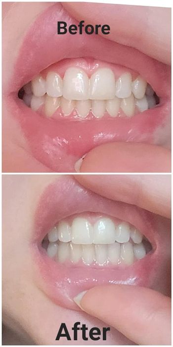 A before-and-after image from a reviewer, showing their teeth after using the whitening pen for one month, with visible improvement.