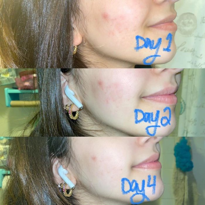 Before-and-after shots showing a noticeable reduction in redness and acne on the reviewer's cheeks by day 2 and day 4.