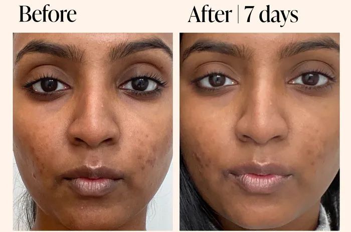 A model's before-and-after photos showing the effects of using Superhue for 7 days, with dark spots visibly lightened.