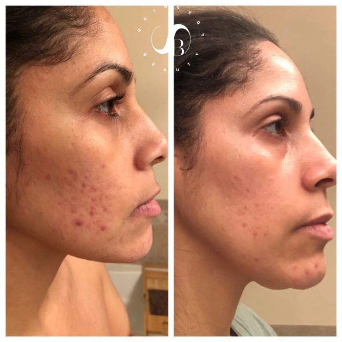 A customer’s before and after photo showcasing a visibly clearer complexion after using the serum.