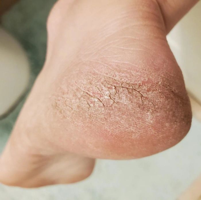A reviewer's dry, calloused heel before using the foot file.