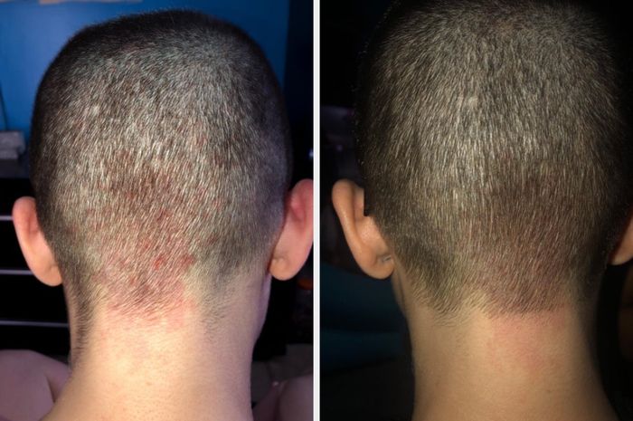 A reviewer showing an irritated scalp and a follow-up image where the redness is gone