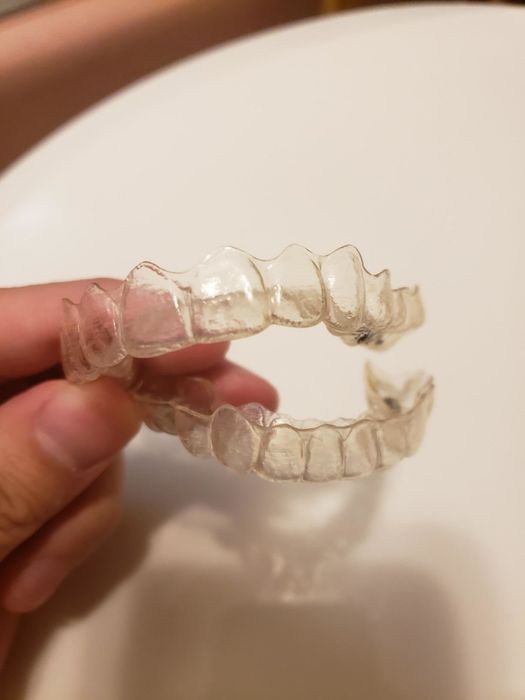 The same Invisalign, now looking noticeably cleaner