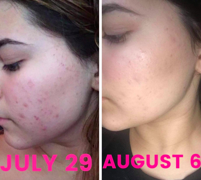 A customer review showing before-and-after photos of their face after using African Black Soap.