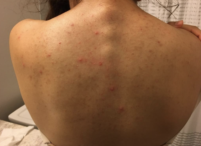 A customer review showing a photo of their back covered in acne before using the body wash