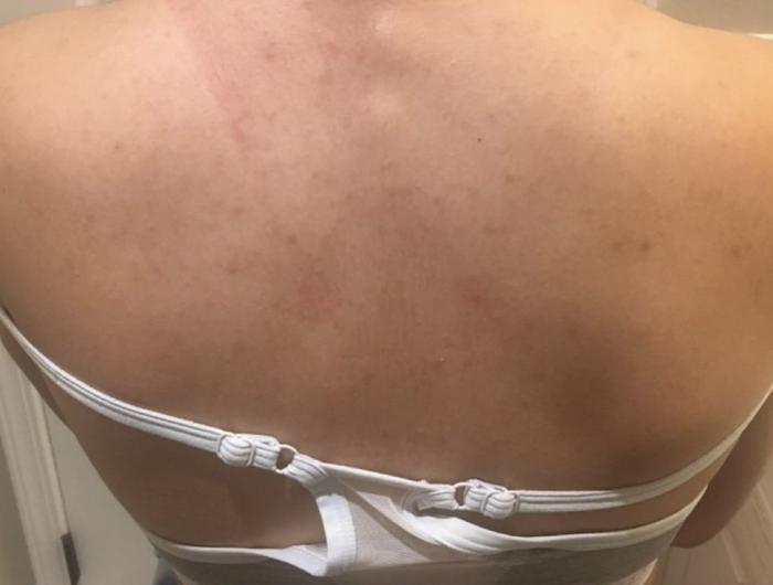 A customer review showing a photo of their back completely clear of acne after using the body wash for one month