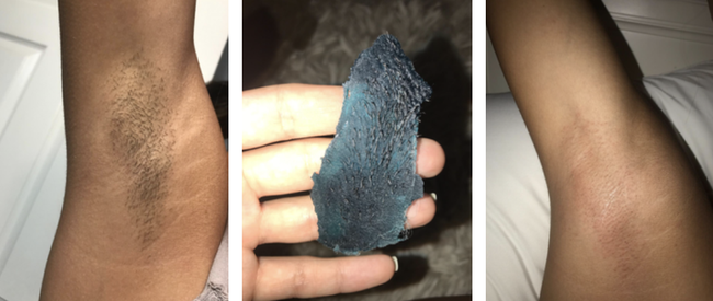 Reviewer before and after photos showing the results of blue wax on underarms