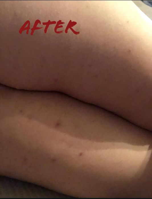 Before image of razor bumps on thighs