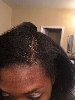 A reviewer shows a photo with visible white flakes along their scalp